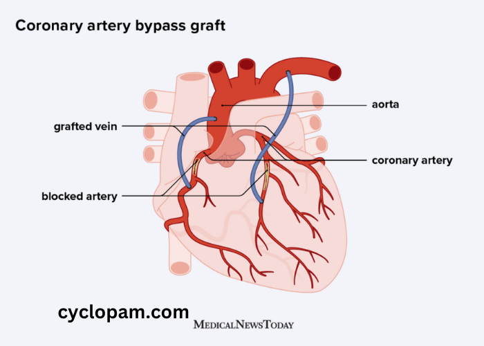 Heart Bypass Surgery Cost